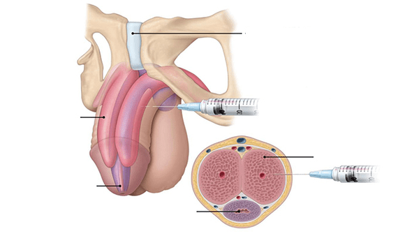 injection of your own fat tissue for penis thickness